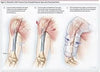 Humeral Brace arm support