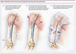 Humeral Brace arm support