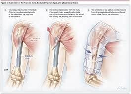 Humeral Brace arm support
