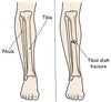 Tibia brace For Leg, calf and Fibula Fracture Support - DEBIK