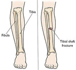 Tibia brace For Leg, calf and Fibula Fracture Support - DEBIK